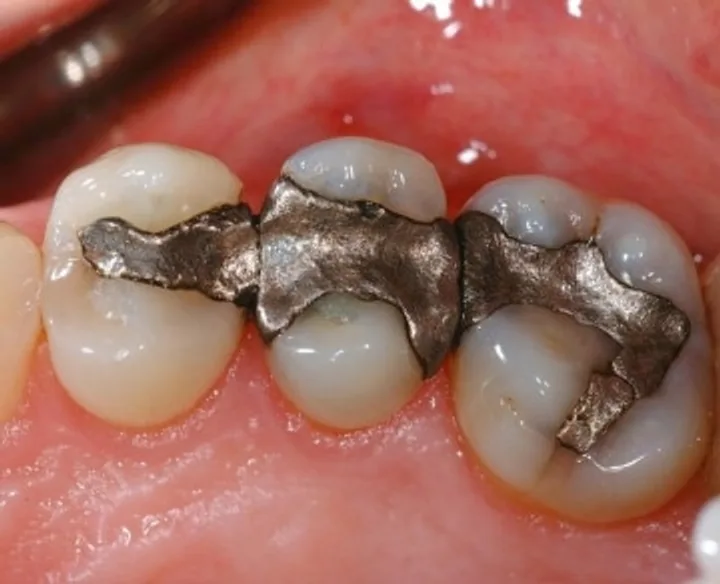 Close-up of old silver amalgam fillings in molars, the kind composite fillings replace