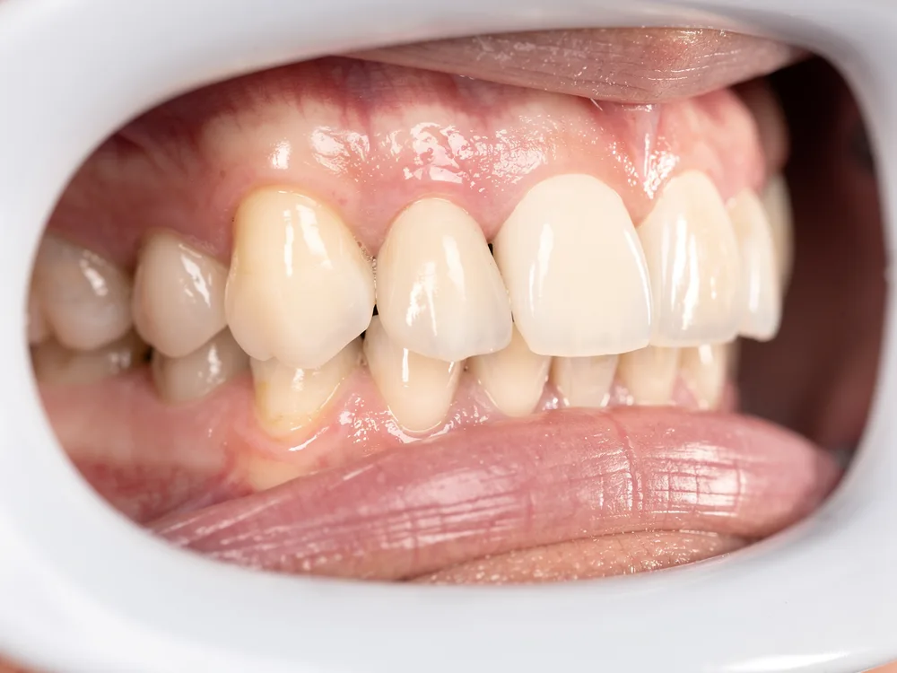 A seated all-ceramic crown blending with natural molars, no metal line at the gum