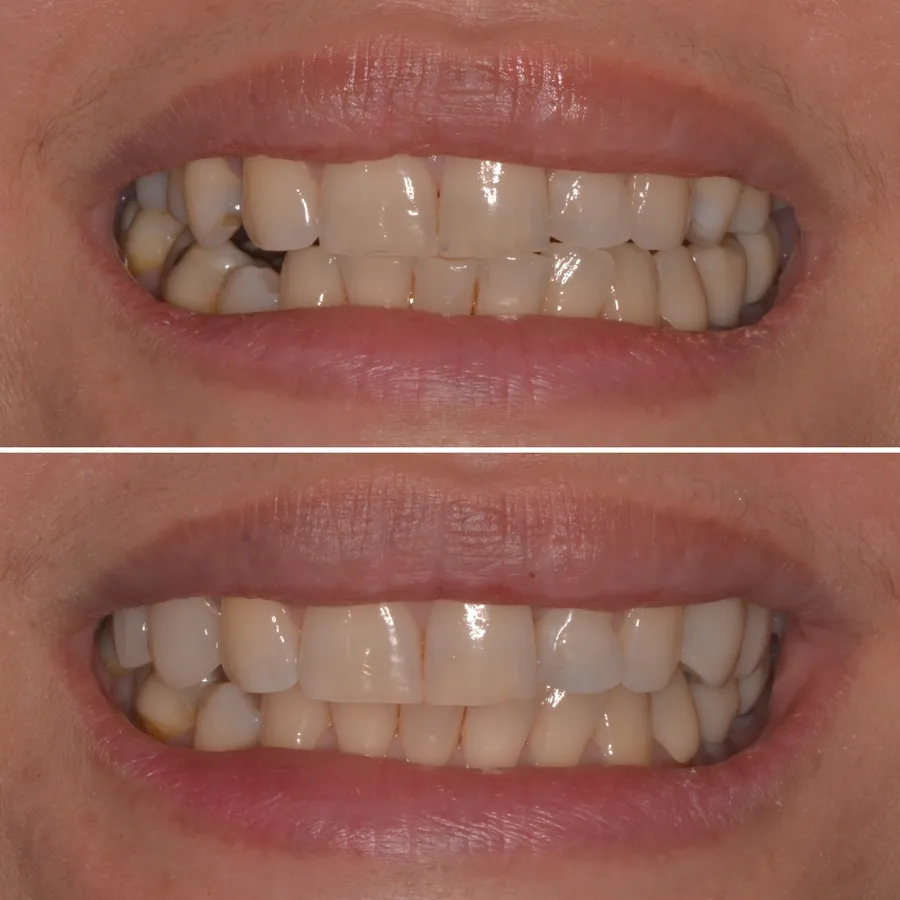 Before and after of an actual Infinity Dental Wellness patient smile in Fort Lee, NJ