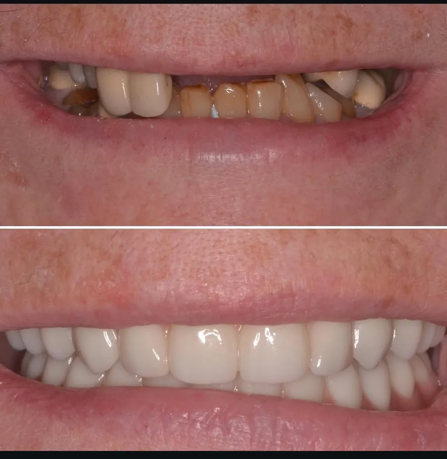 Before and after of an actual Infinity Dental Wellness patient's full restoration by Dr. Odinsky in Fort Lee, NJ