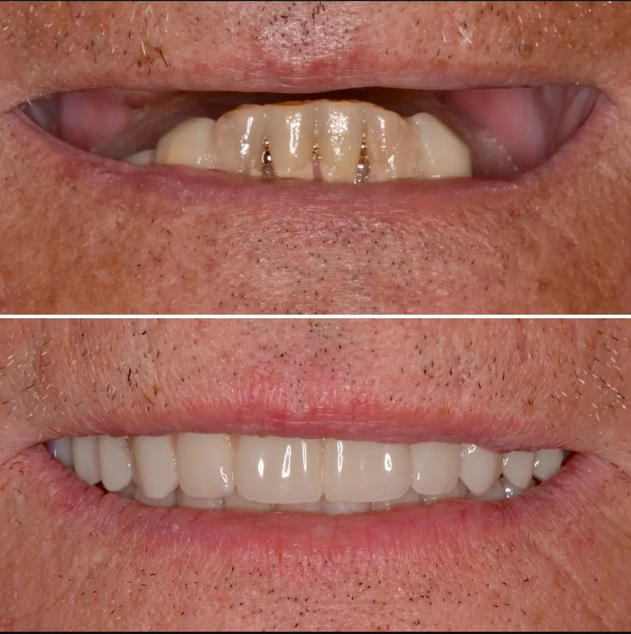 Before and after of an actual Infinity Dental Wellness patient's implant-supported restoration in Fort Lee, NJ