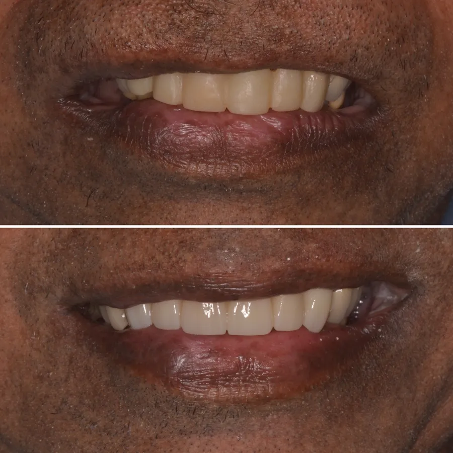 Before and after of an actual Infinity Dental Wellness patient smile restored by Dr. Odinsky in Fort Lee, NJ