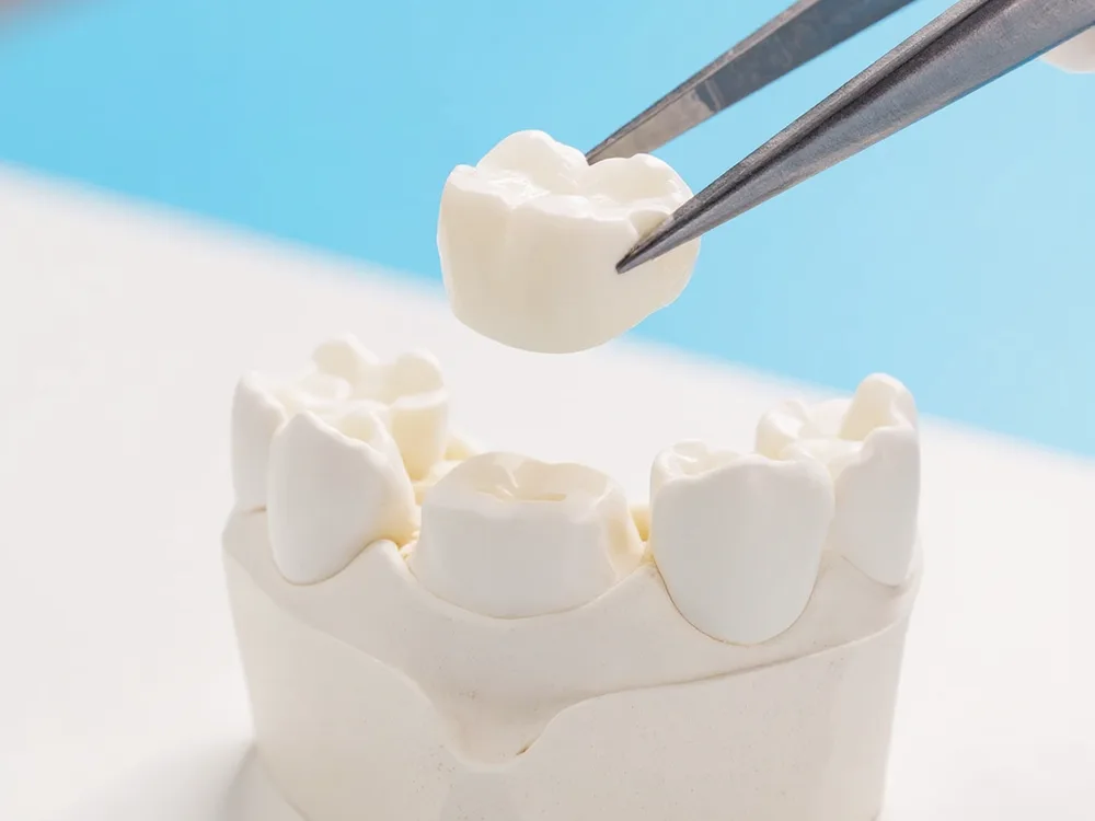 A white zirconia crown being seated on a dental model in the lab