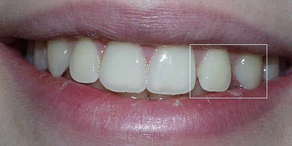 avalon-before