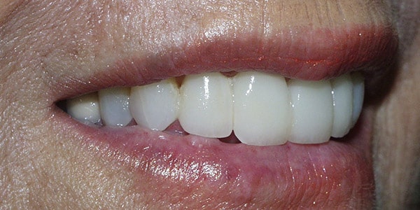 laurel-after