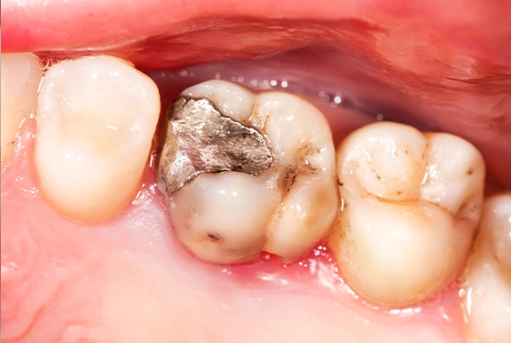 safe-mercury-removal